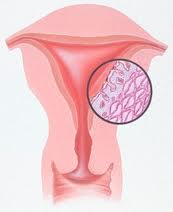 лечение эндометриоза физическими упражнениями