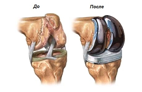 операция по эндопротезированию коленного сустава