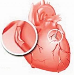 Ишемическая болезнь сердца: симптомы, лечение