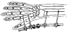 Механизм перелома костей предплечья