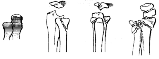 Перелом костей предплечья в типичном месте