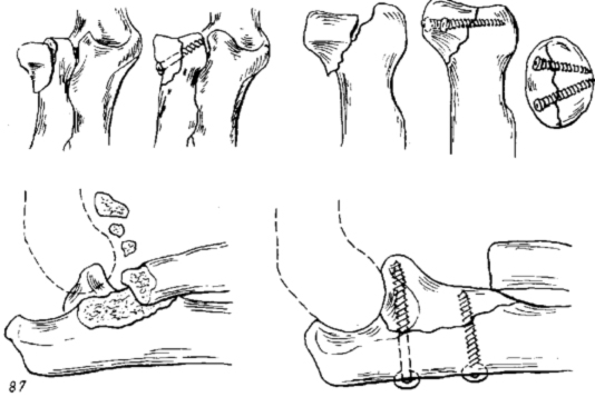 Перелом костей предплечья в типичном месте