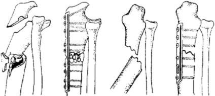 Остеосинтез при переломе обеих костей предплечья