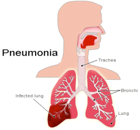 Пневмония – симптомы и лечение